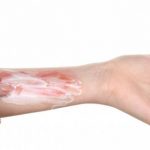 نصائح طبية للإسعافات الأولية للحروق الحرارية