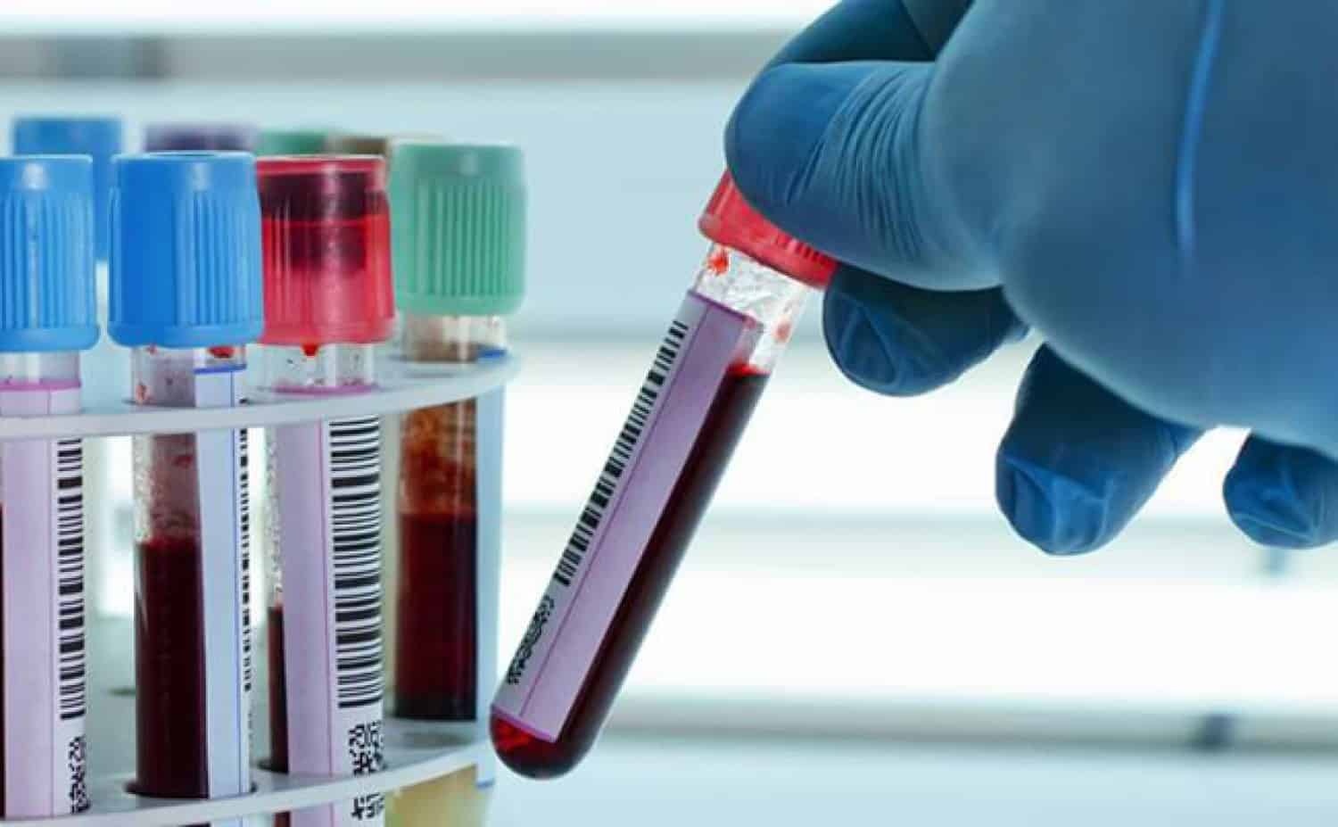 فحص الدهون الثلاثية ضروري لهؤلاء الأشخاص