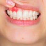 6 طرق طبيعية للتخلص من التهاب اللثة