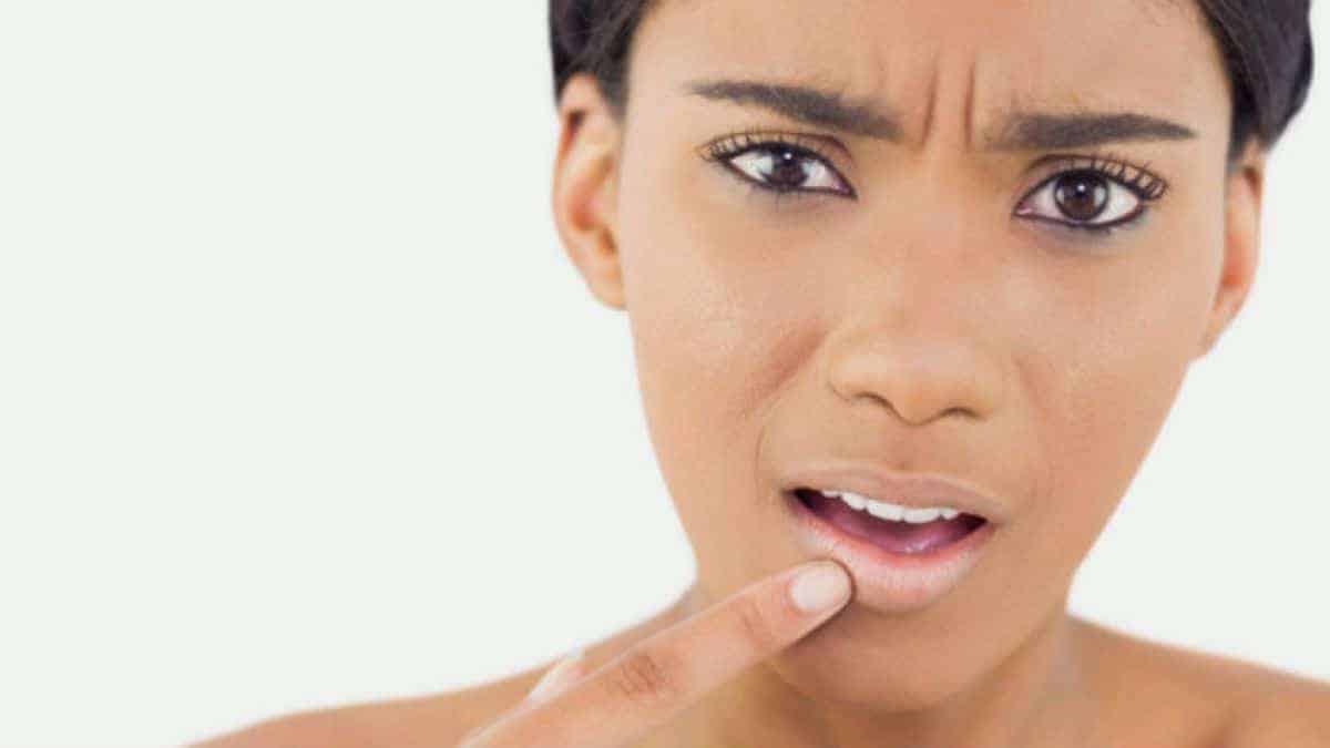 10 أسباب تؤدي إلى ظهور حبوب الشفاه والفم