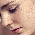طرق التخلص من النمش في المنزل