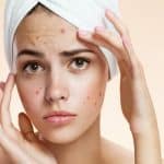 حب الشباب لدى البالغين