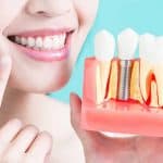 4 حالات يمنع فيها إجراء عمليات زراعة الأسنان