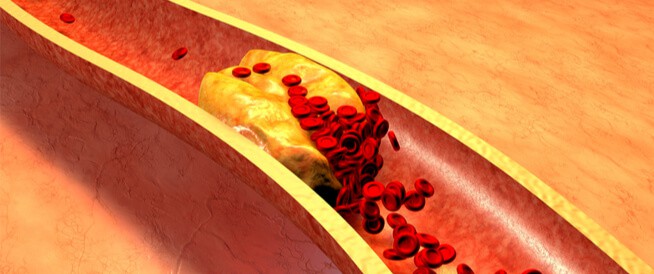 أسباب انسداد شرايين القلب