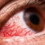 حقيقة انتقال فيروس كورونا بالعين.. هل سيتحول كوفيد25 لواقع؟