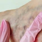 تخثر الأوردة أهم أعراضه وكيفية الوقاية منه