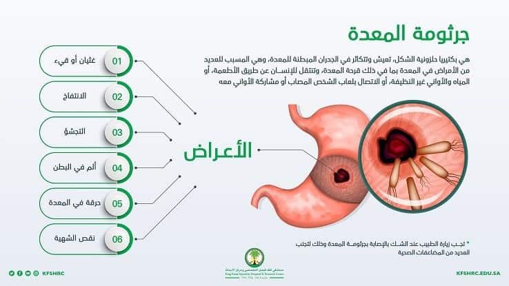ما هي جرثومة المعدة وأعراضها؟ «مستشفى الملك فيصل» تجيب