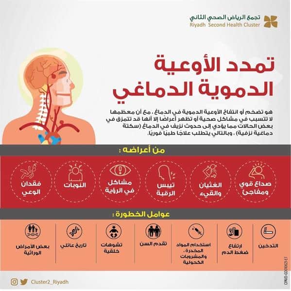 ماذا يعني تمدد الأوعية الدموية الدماغي؟ «سعود الطبية» تجيب