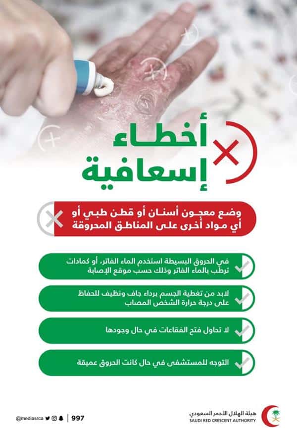 «الهلال الأحمر» يكشف أبرز الأخطاء الإسعافية المتبعة عند التعامل من المصاب بحروق