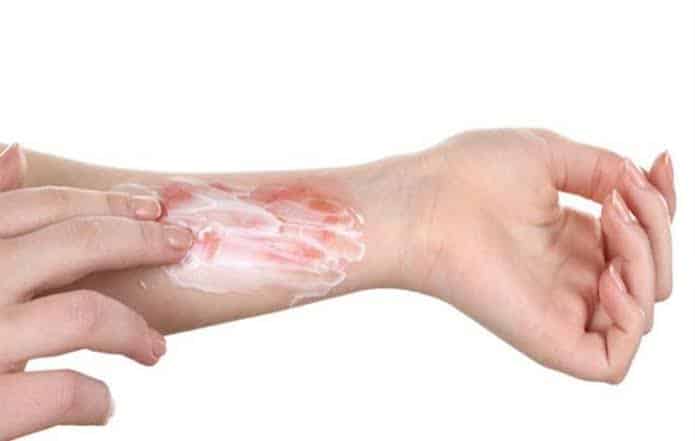 أضرار معجون الأسنان على الحروق.. «مجلس الصحة» يوضح