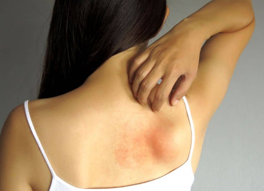 خلطات منزلية لعلاج حبوب الظهر والتخلص منها نهائيًا