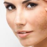 علاج الكلف القديم بوصفات طبيعية من منزلك