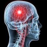 هل مضاعفات الشقيقة تؤدي للسكتة الدماغية؟ .. «استشاري» يكشف 