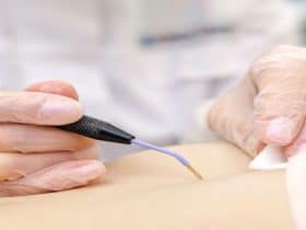 هل الكي بالنار مفيدًا لعلاج جلطات القلب؟