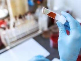 اختبار دم يكشف عن سرطان الرئة مبكرا