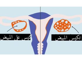 سرطان المبيض