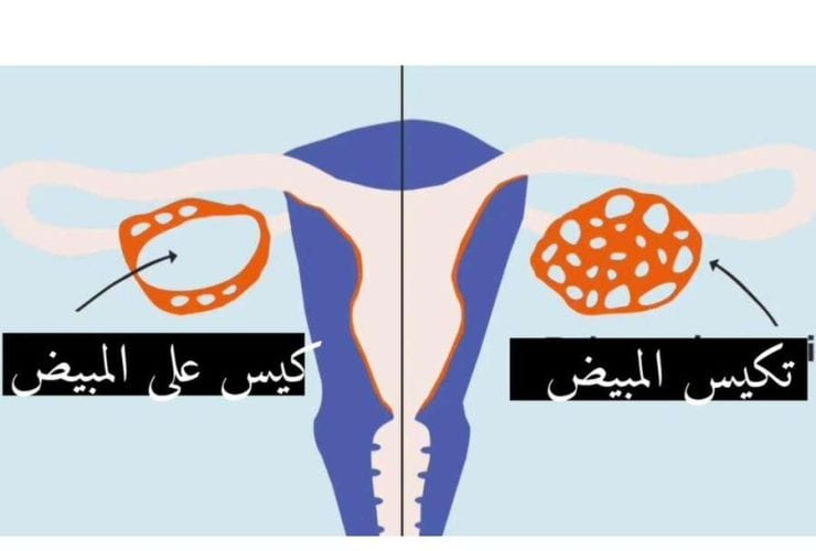 سرطان المبيض