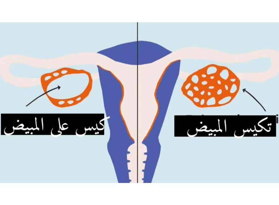 ما هو الفرق بين التكيس و كيس المبيض؟