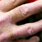 الصدفية