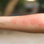 الفطريات الجلدية