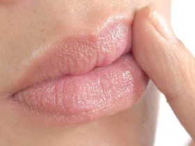 تشققات زوايا الفم