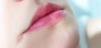 تشققات زوايا الفم