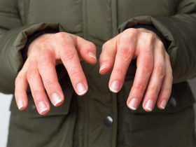 قضمة الصقيع