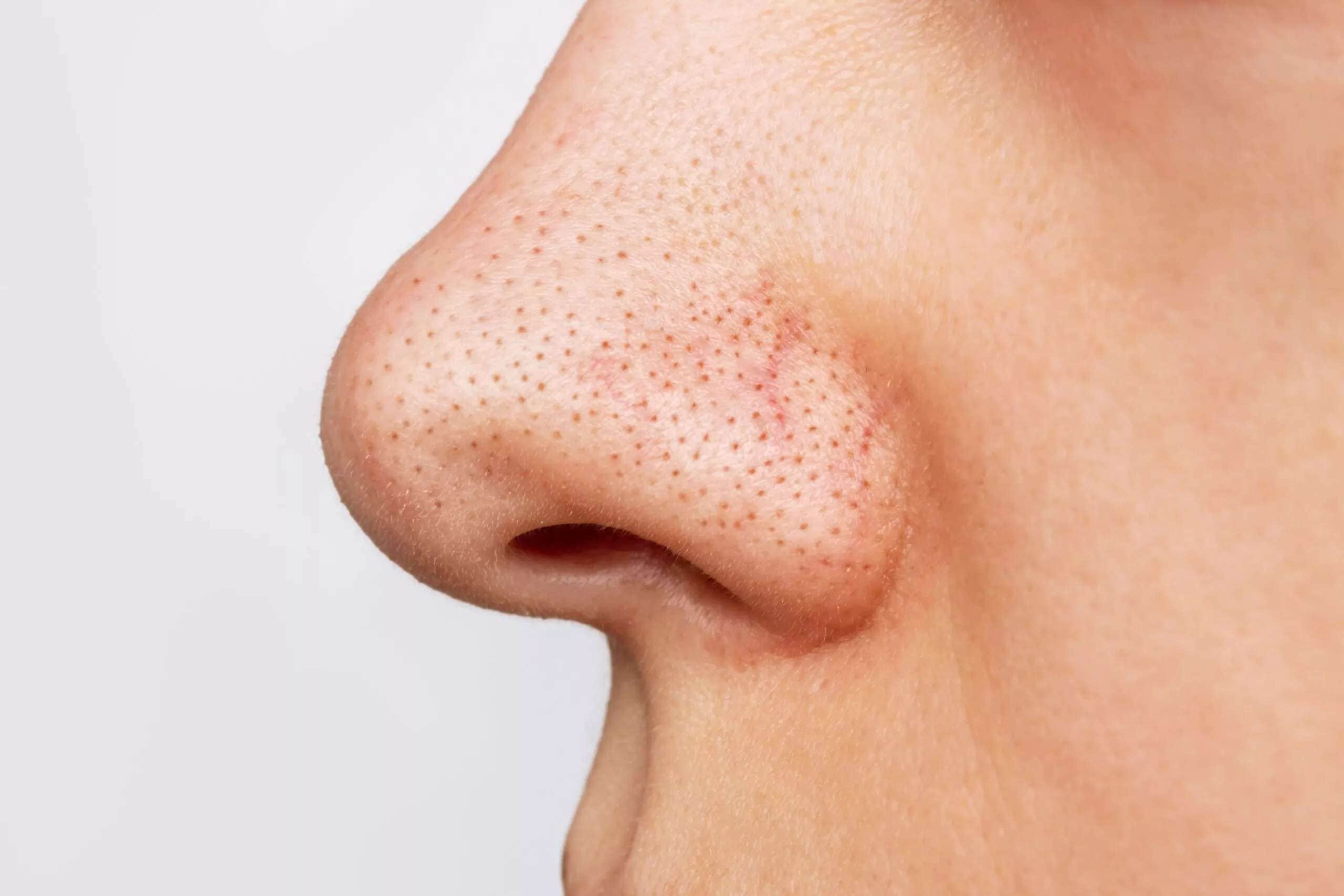 طرق التعرف على الرؤوس السوداء والبيضاء.. وكيفية علاجها