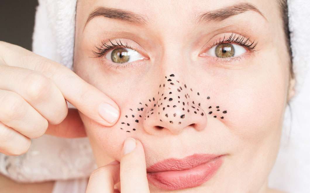 طرق التعرف على الرؤوس السوداء والبيضاء.. وكيفية علاجها