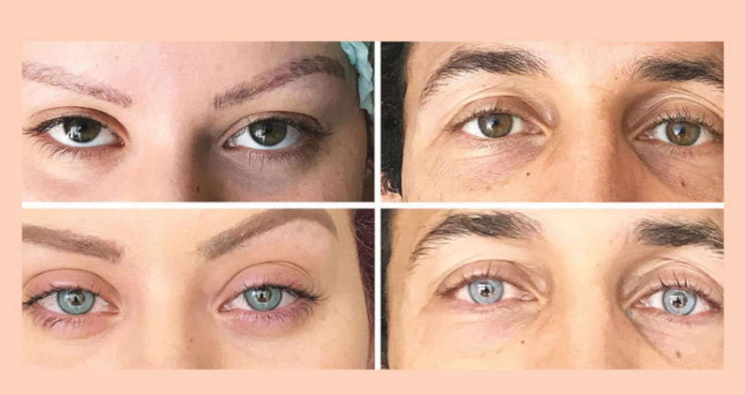 عمليات تغيير لون العين