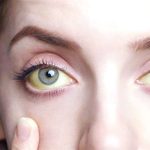 الحمى الصفراء