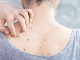 أسباب زيادة حبوب الظهر في الصيف