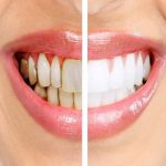 حيل منزلية لعلاج تسوس الأسنان