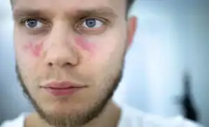 ما هو مرض الذئبة؟ الأعراضه والوقاية