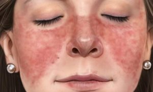  ما هو مرض الذئبة؟ الأعراضه والوقاية