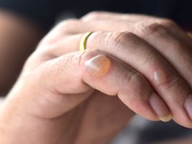 أسباب ظهور الفقاعات