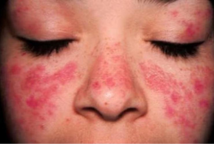 ما هو مرض الذئبة؟ الأعراضه والوقاية