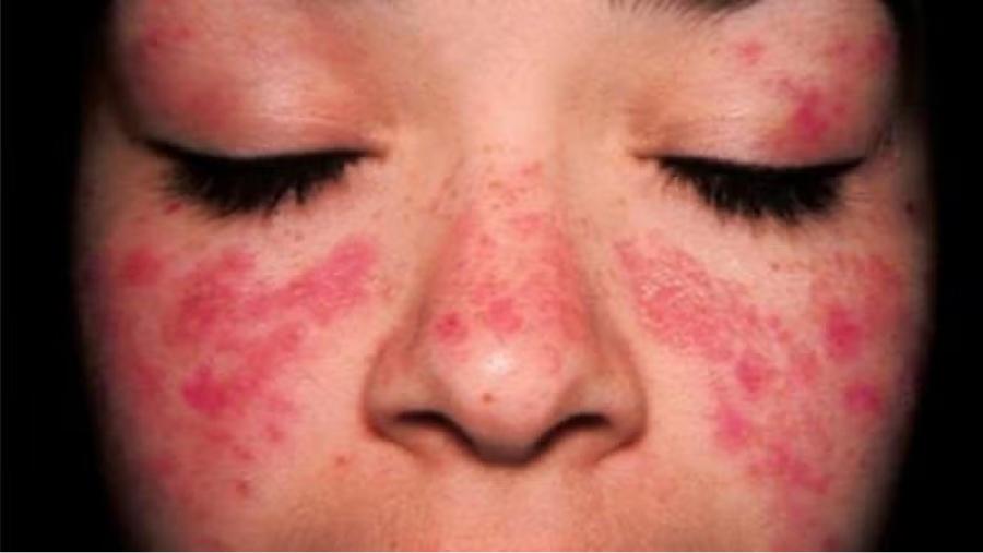 ما هو مرض الذئبة؟ الأعراضه والوقاية