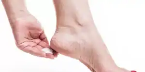 تشققات القدم