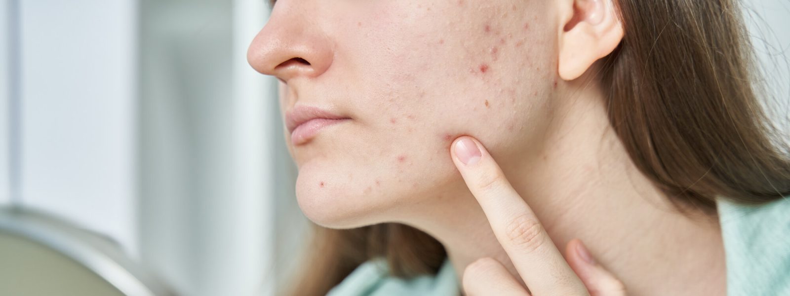 كيف تتخلصين من ندبات حب الشباب ؟..نصائح