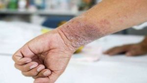 التهاب الجلد البكتيري