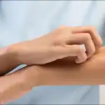الحكة