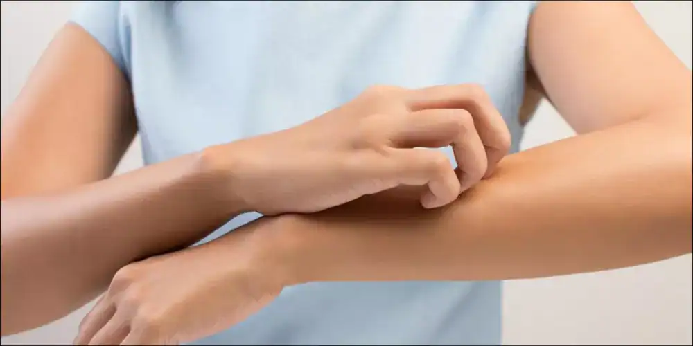 الحكة