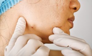 مكافحة حب الشباب بالعلاجات المنزلية.. 8 حلول