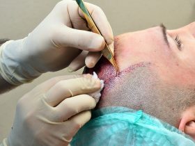 هل زراعة الشعر استعادة الثقة بالنفس أم مشكلات طبية..تفاصيل