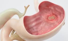 قرحة المعدة