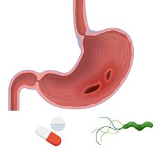 قرحة المعدة