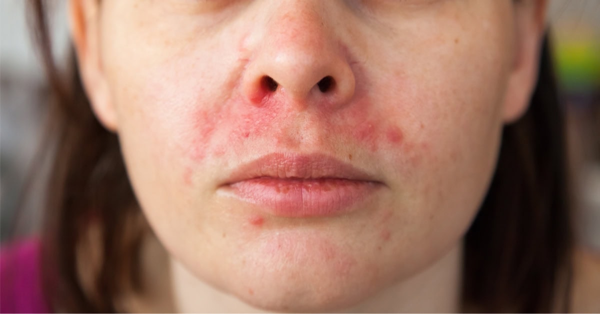 ما هي حساسية الشمس ؟..اعراضها وطرق الوقاية منها