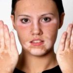 أسباب البهاق.. من أسرار وعلاجات