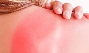 طرق تخفيف حروق الشمس